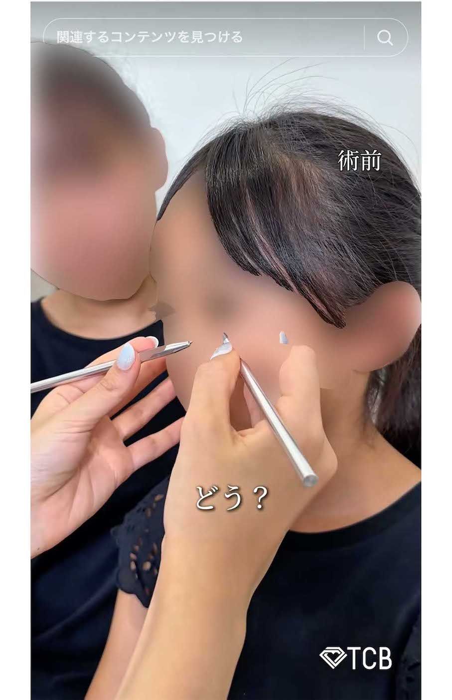 夏休み中の10歳の女子小学生が二重整形を受ける様子を動画投稿したTCB東京中央美容外科・新宿東口院の医師（TikTokより）