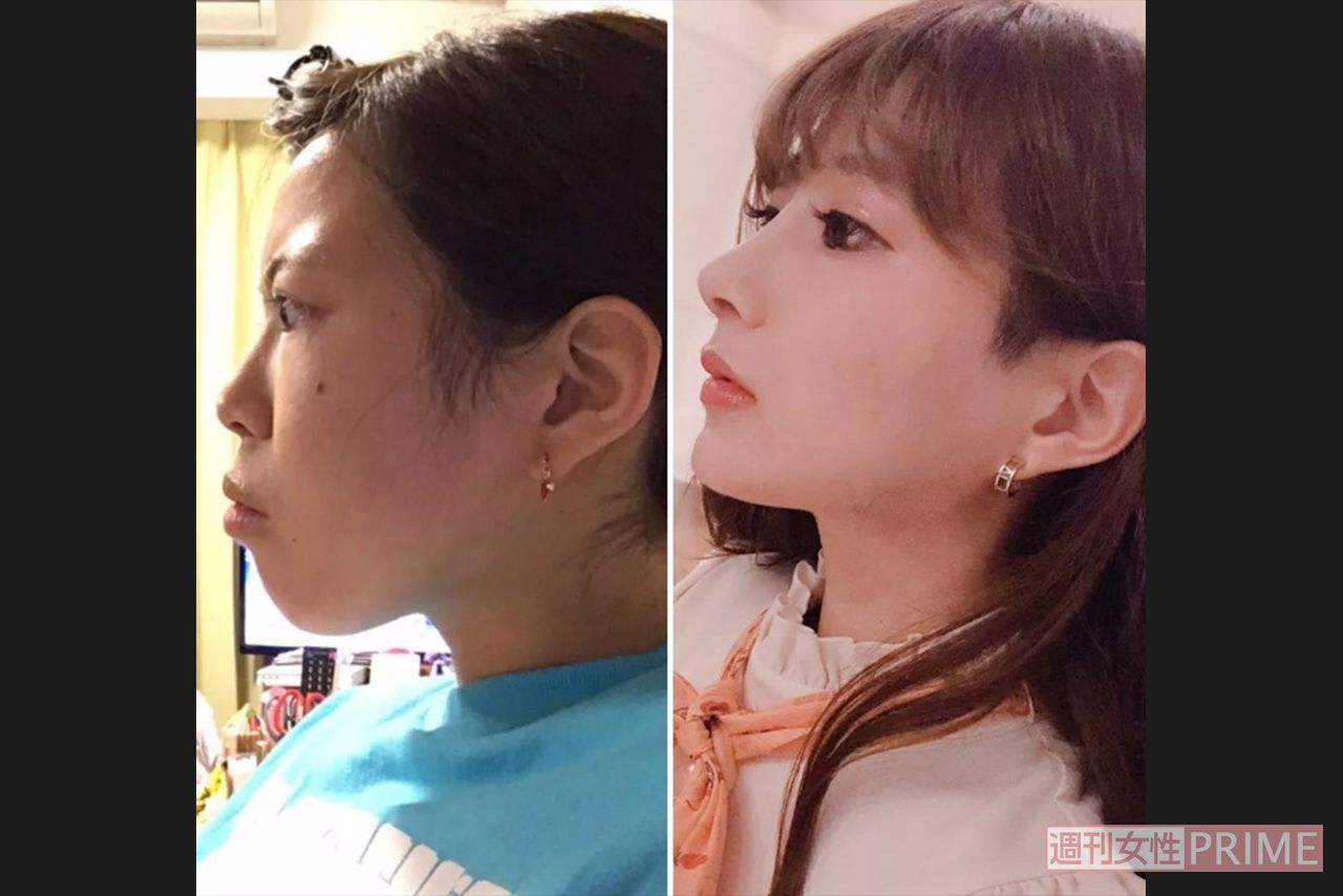 セクシー女優・高嶋めいみさんの整形ビフォー（左）とアフター（右）