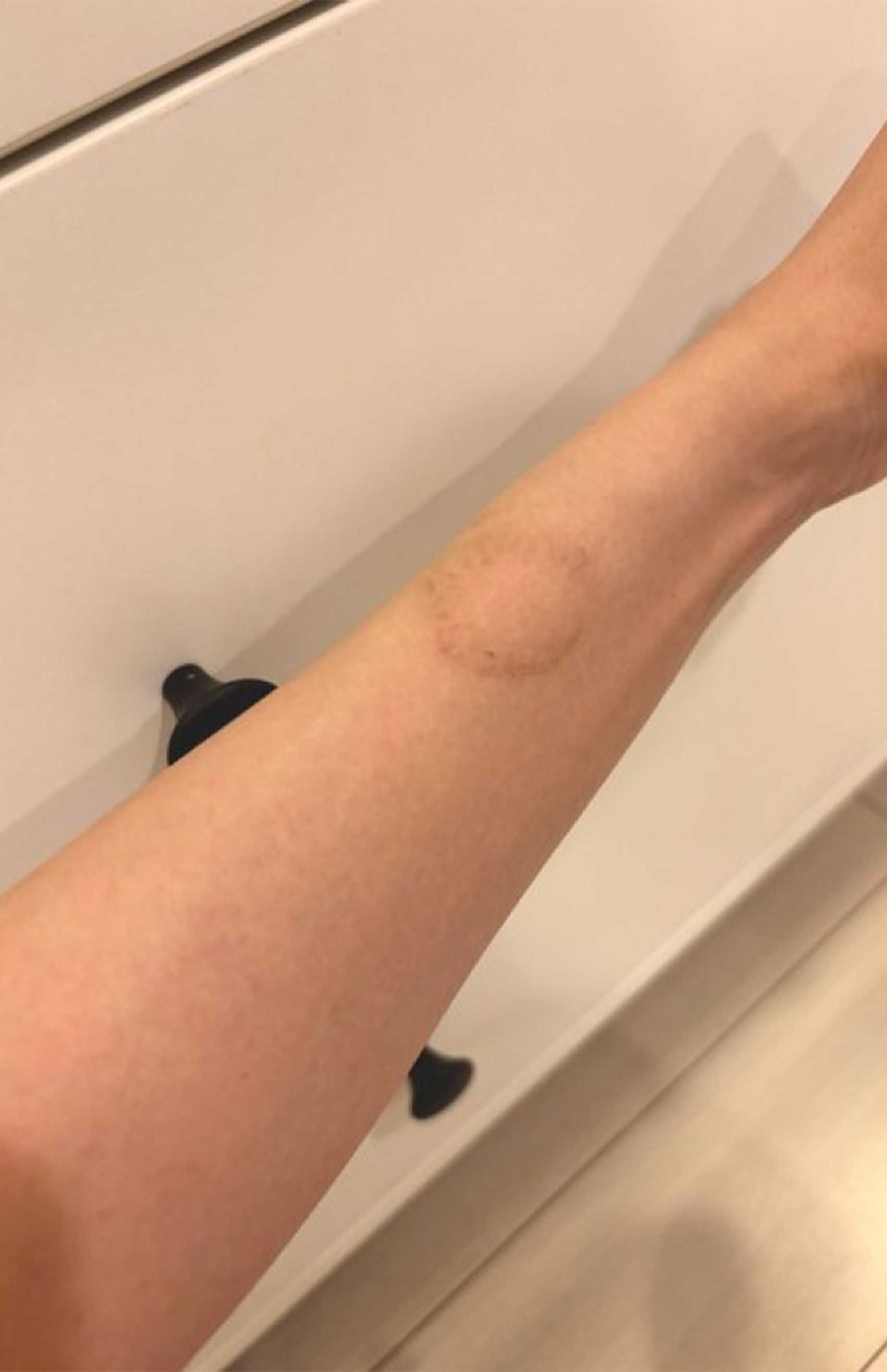 現在、犯人に噛まれた梁さんの腕の傷は回復しつつあるという