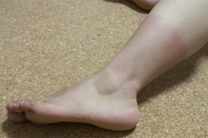 日焼けによる紫外線ダメージの蓄積はシミの原因に！（※画像はイメージです）