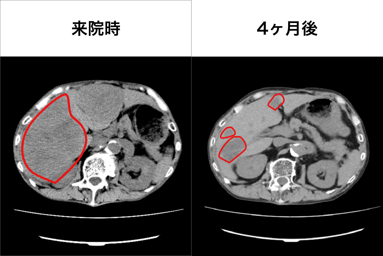 胃がん患者IさんのCT腹部画像（写真提供／船戸クリニック）