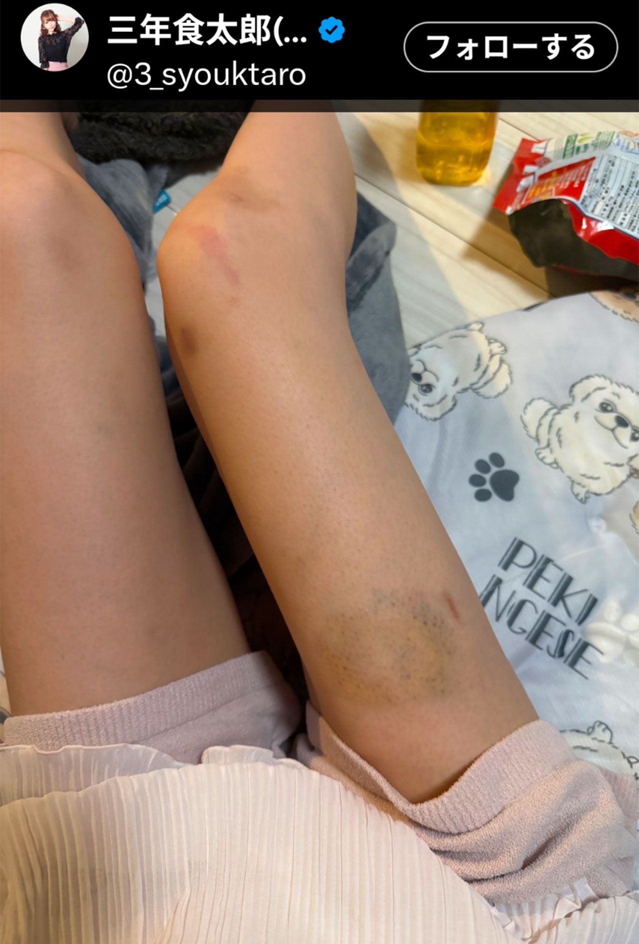 あざが痛々しい大食いYouTuberの三年食太郎（本人のXより）