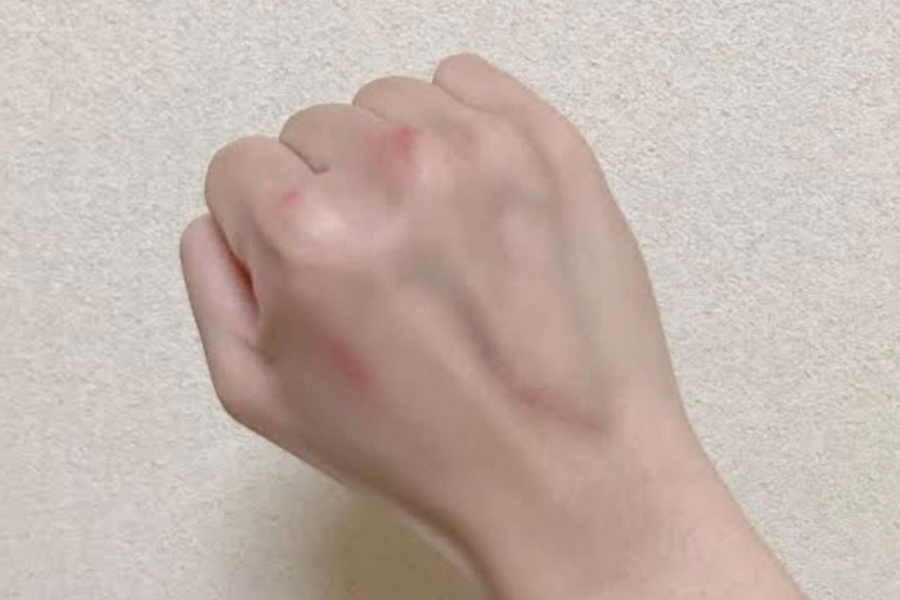 手を喉に突っ込み嘔吐するときに写真のようなタコができるようになる。これが「吐きダコ」と呼ばれ、大食い系ユーチューバーなどの手を見る視聴者も多い