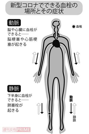 新型コロナでできる血栓の場所とその症状