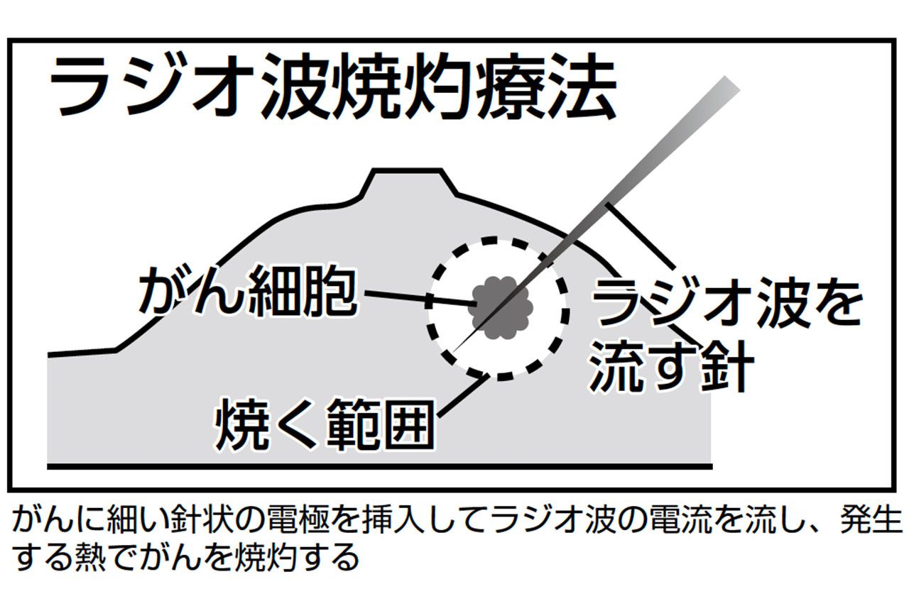 ラジオ波焼灼療法の図解