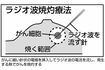 ラジオ波焼灼療法の図解