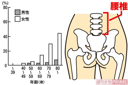 年齢別骨粗しょう症の割合　出典:骨粗しょう症の予防と治療ガイドラインより