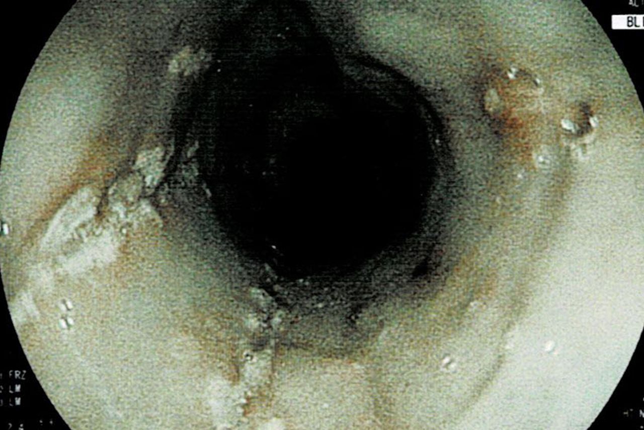 カンジダ（カビ）感染が疑われる食道のカメラ画像、白くプチプチしたものが目視できる