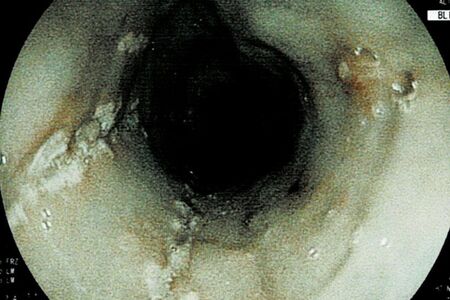 カンジダ（カビ）感染が疑われる食道のカメラ画像、白くプチプチしたものが目視できる