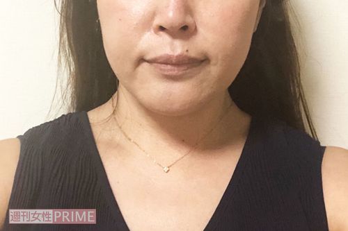 2週間後、かなり輪郭がシャープに！