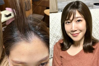 髪が多かったみずきさんだが、1月になると抜け毛も増えている（写真左）。右は完成したウィッグをかぶったところ