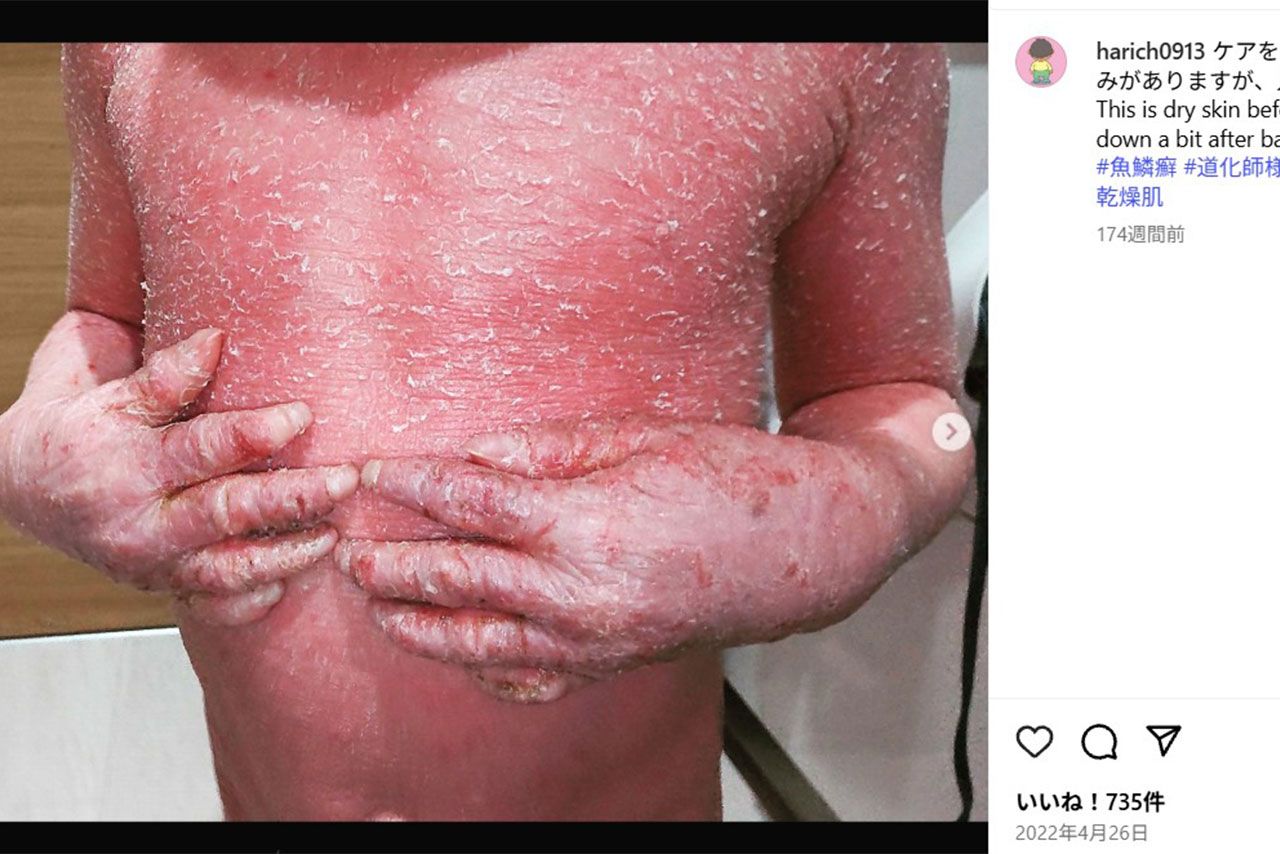 『道化師様魚鱗癬』を患う賀久くん