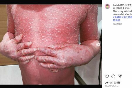 『道化師様魚鱗癬』を患う賀久くん