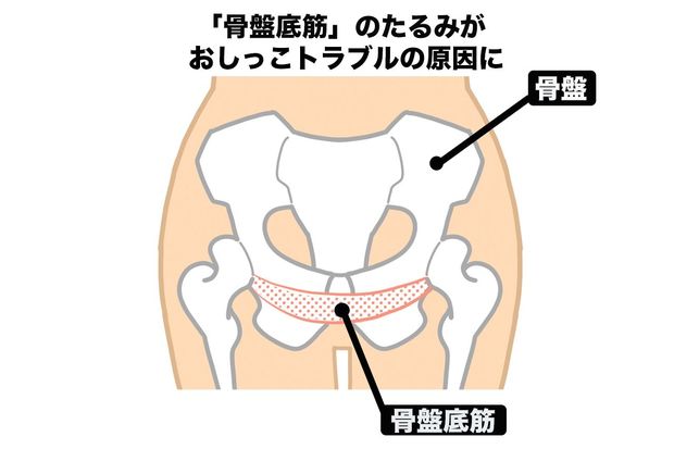 「骨盤底筋」のたるみがおしっこトラブルの原因に