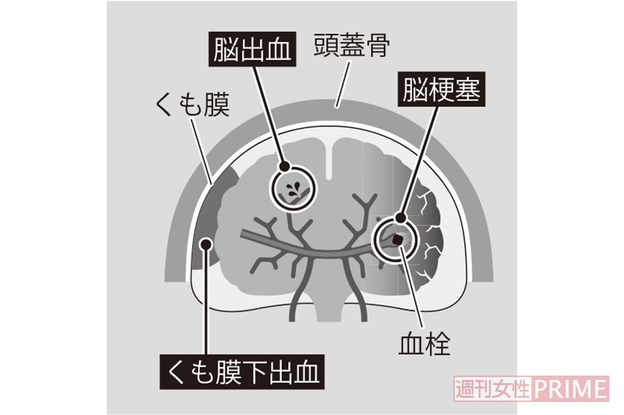脳卒中