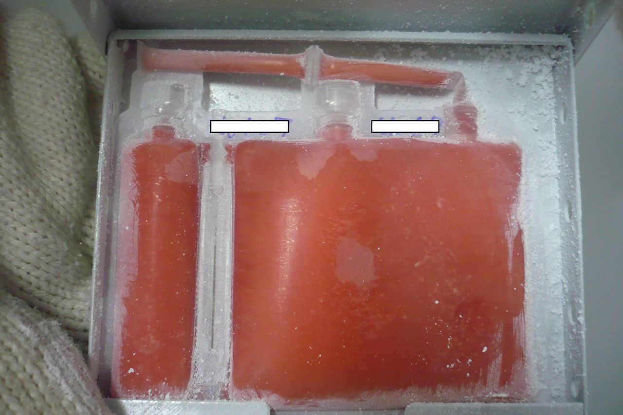 パックに詰められたさい帯血