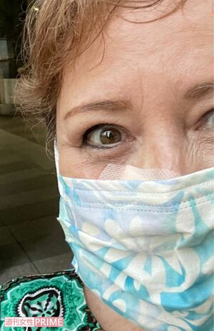 2度目の皮膚がん手術、退院の日のキャシー中島さん。1mmのがん細胞なのに、横3cm、縦1cmを切除。顔の中心部で目立つ箇所だが、担当医師が丁寧に縫ってくれた