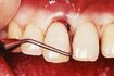 歯根の奥にある汚れは歯ぐきを切開し取る