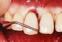 歯根の奥にある汚れは歯ぐきを切開し取る