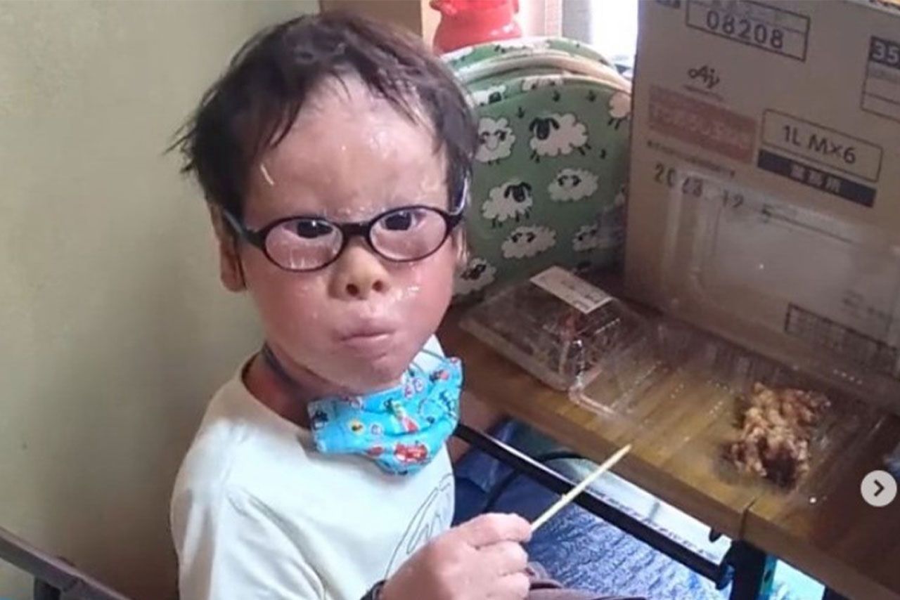 『道化師様魚鱗癬』を患う賀久くん