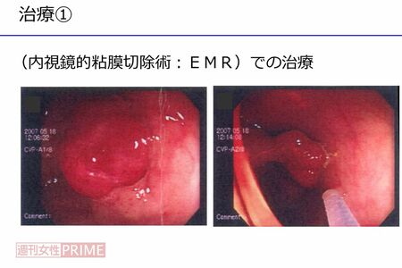 内視鏡的粘膜除去手術で大腸のポリープの摘出を行った。このポリープが悪性だったのだ