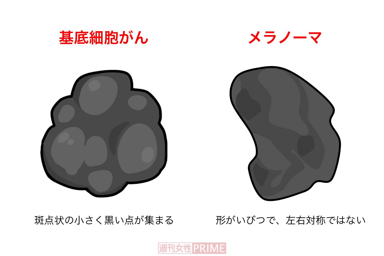 皮膚がん　イラスト／青井亜衣