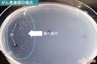 がん患者尿の場合