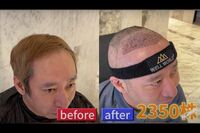 いしだ壱成の頭髪への誹謗中傷に憤り！トルコ植毛手術同行者が語る「毛根2350株」のお値段