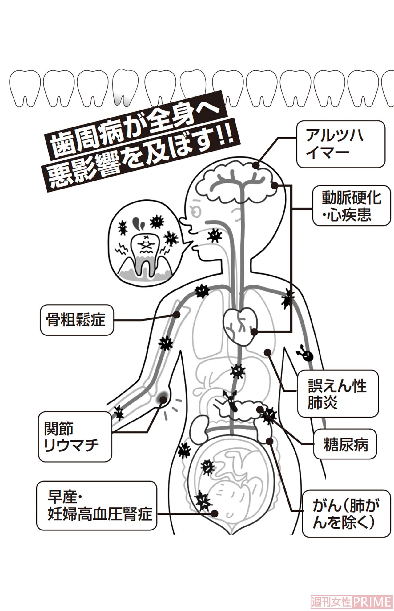 歯周病が全身へ悪影響を及ぼす！　イラスト／とげとげ。