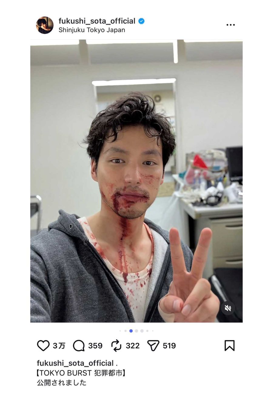ズタボロの顔でピースサインをする福士蒼汰（本人のインスタグラムより）