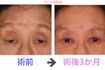 眼瞼下垂の手術を受けた患者のビフォーアフター 写真提供=小室主任教授