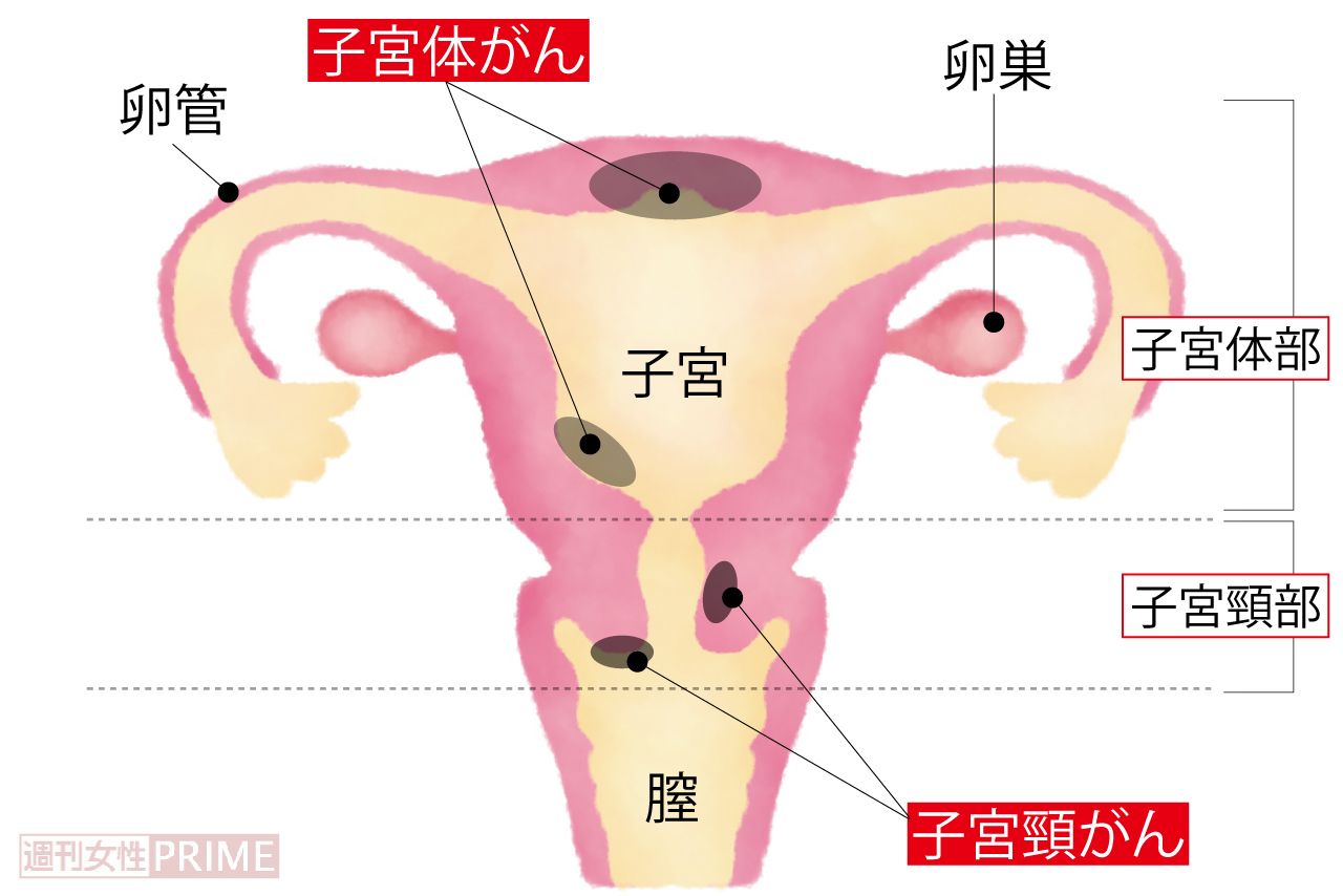 子宮頸がんの多くは、子宮頸部の入り口である外子宮口のあたり。子宮体がんは「子宮内膜がん」ともいわれ、子宮内膜に多く発生する