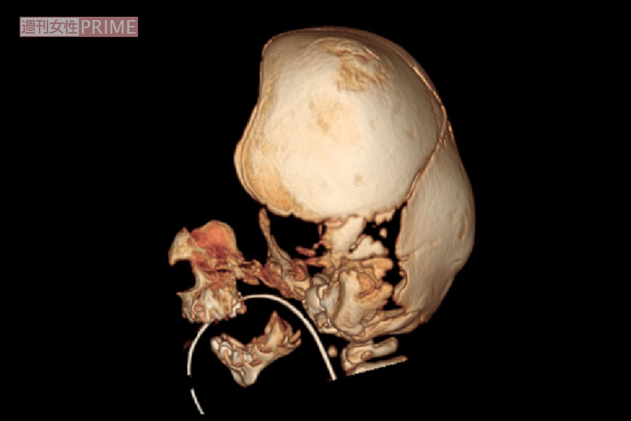 生後4か月のころのCT結果3D再現画像