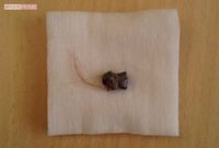 摘出された長さ約8ミリの鉛弾