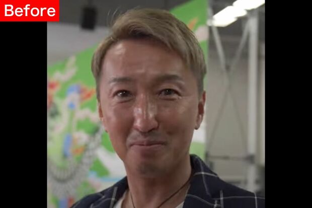 【Before】全体的にたるみが気になる。目の下のくまと加齢によりついた脂肪で左右のバランスが崩れた状態に。顔全体のたるみが気になっていた。