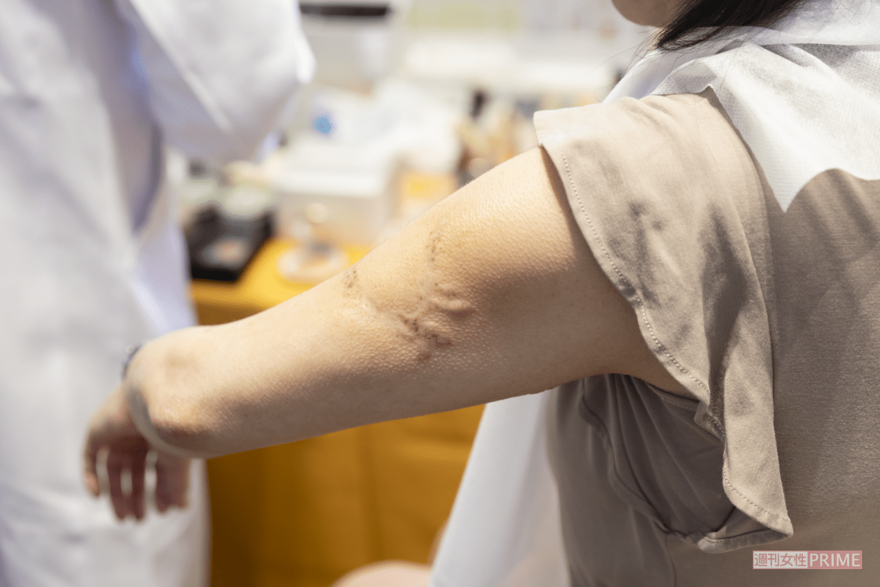 幼稚園のころから、ケロイドに悩んできたAさんは、リハビリメイクで目立たなくなると、「ふたをしていた気持ちが突然開いたみたい……」と喜び、涙した（撮影／矢島泰輔）