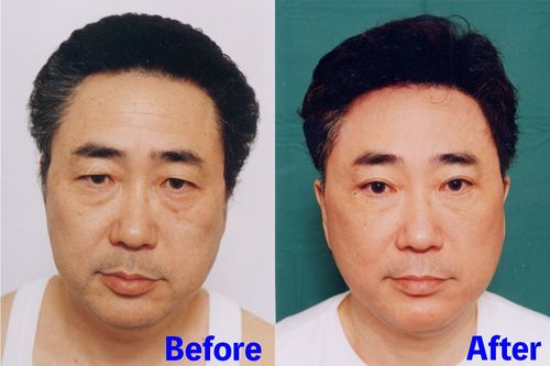 高須院長が自ら行ったフェイスリフトによる若返り施術。左が施術前、右が施術後