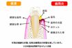 歯周病をわかりやすくイラストで紹介