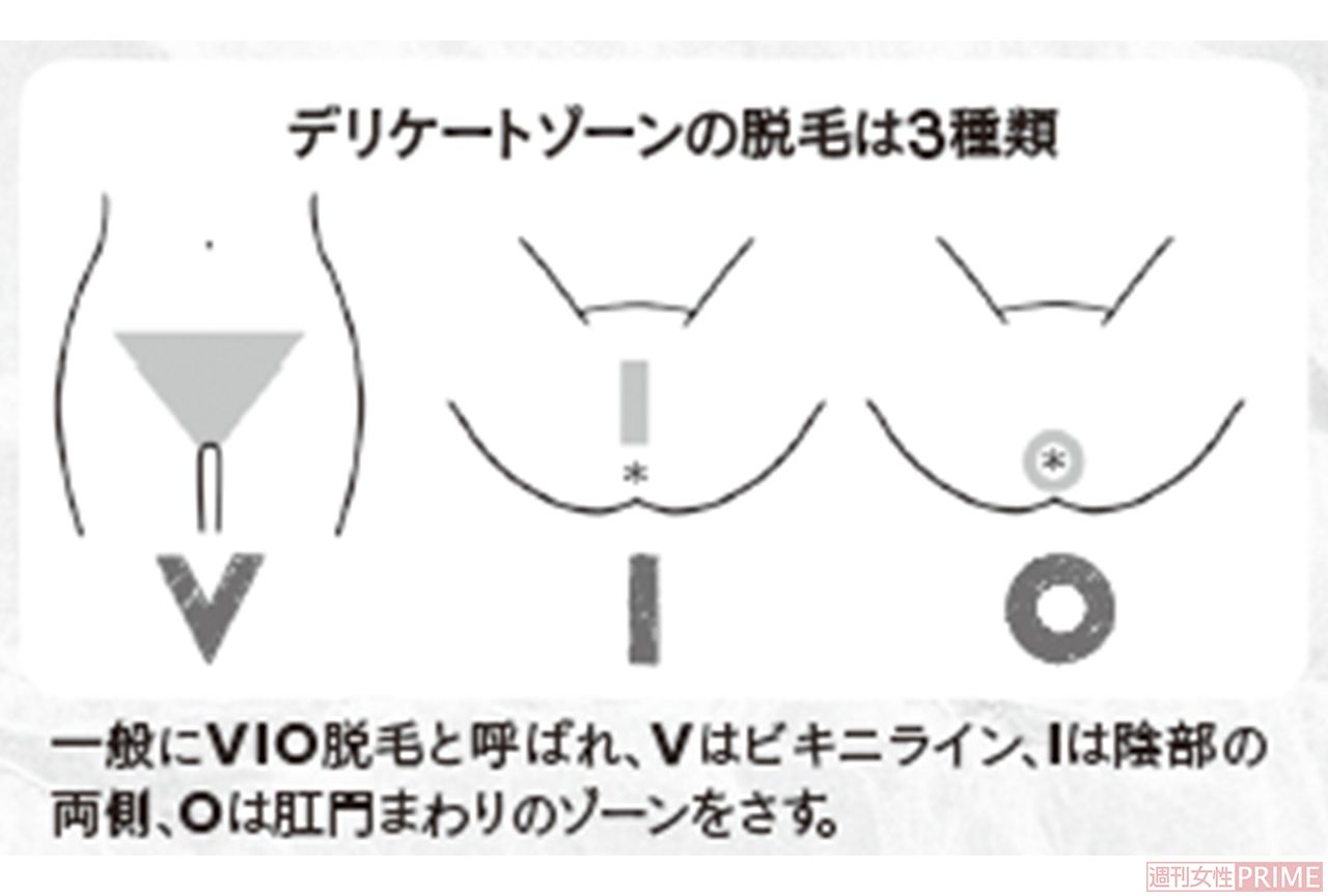 デリケートゾーンの脱毛は3種類　イラスト／上田惣子