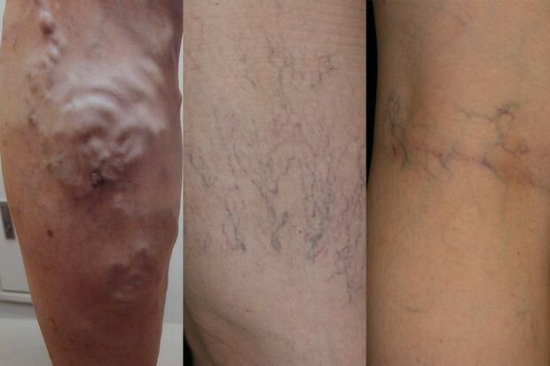 （左から）大伏在静脈瘤、網目状静脈瘤、クモの巣状静脈瘤。血管がボコボコと浮き出る状態のほか、血管の盛り上がりはないものの、血管が青い網目状に浮き出て見えたり、細い血管がクモの巣のように放射状に浮き上がって見えるタイプなどがある。