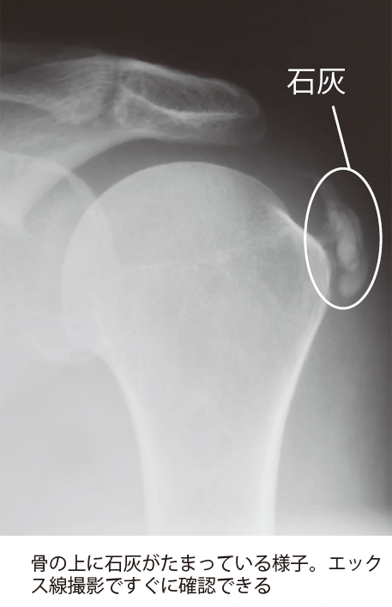 骨の上に石灰がたまっている様子。エックス線撮影ですぐに確認できる
