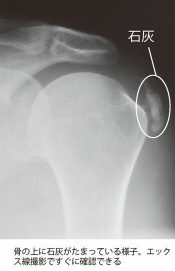 骨の上に石灰がたまっている様子。エックス線撮影ですぐに確認できる