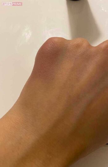 2回目の暴力を受けた際の、絵莉さんの怪我の様子。殴られて転んだとき、左手の小指あたりが青あざに（絵莉さん提供）