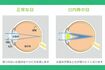 白内障の症状(白内障LAB公式サイトより)