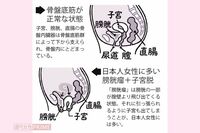 夕方になると股間に違和感、股の間からピンポン玉のようなものが！女性の10人に1人、閉経後に急増する《子…
