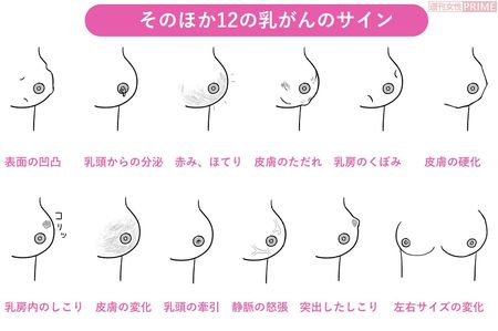 そのほか12の乳がんのサイン　イラスト／スヤマミヅホ