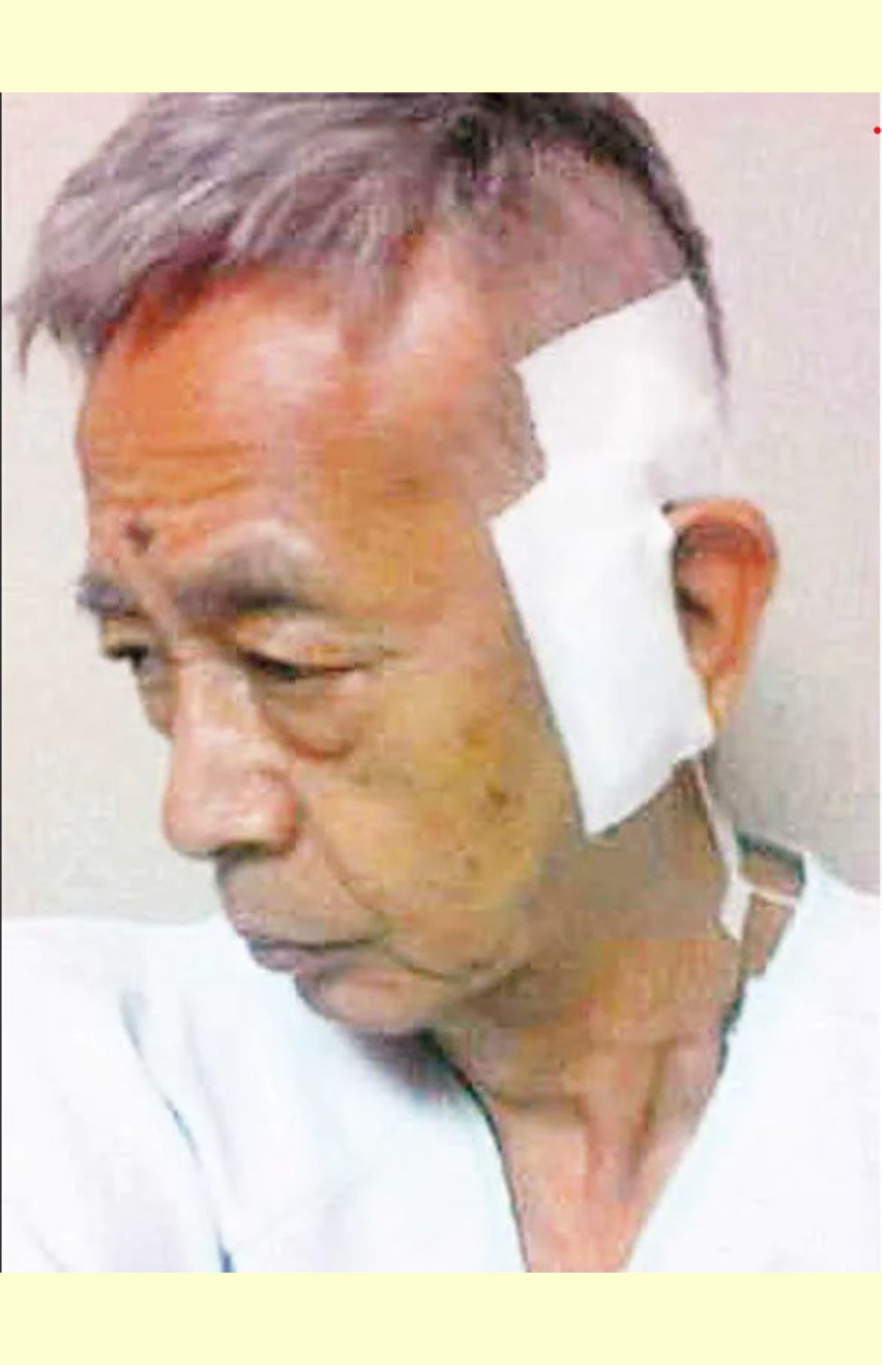 治療中の村野さん。耳の上の動脈に穴を開けて、がんがあるところにカテーテルを入れて抗がん剤を流し込む