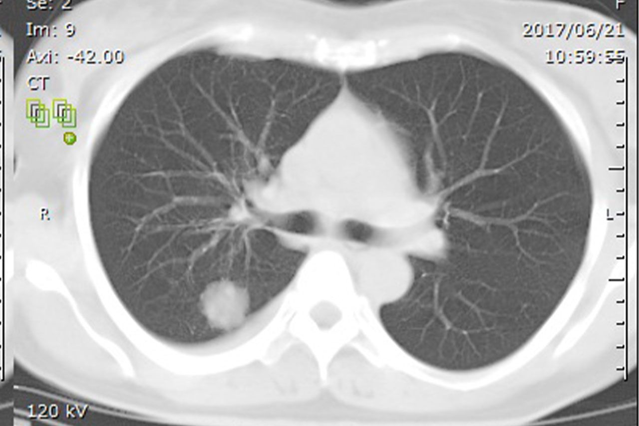 松本みゆきさんが見ても、すぐに「肺がんだ」とわかったというCT画像。白い影がはっきりと写り込む