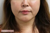 デカ顔に悩み、高須クリニックで小顔化メニューを試した結果「痛みなくシャープに！」