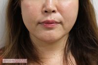 デカ顔に悩み、高須クリニックで小顔化メニューを試した結果「痛みなくシャープに！」